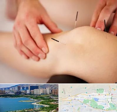 دکتر طب سوزنی برای لاغری در منطقه 22 تهران 