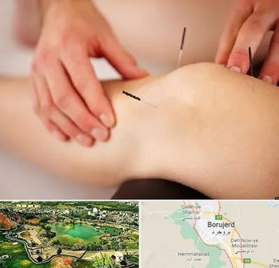 دکتر طب سوزنی برای لاغری در بروجرد