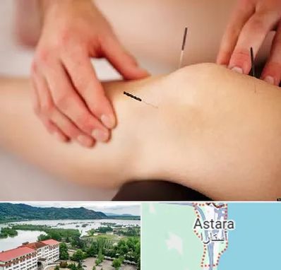 دکتر طب سوزنی برای لاغری در آستارا