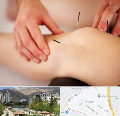 دکتر طب سوزنی برای لاغری در شهر زیبا 