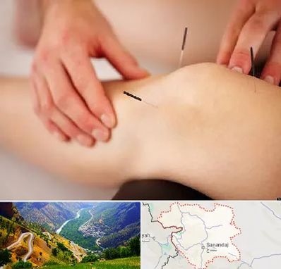 دکتر طب سوزنی برای لاغری در کردستان