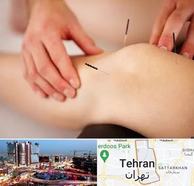 دکتر طب سوزنی برای لاغری در صادقیه 