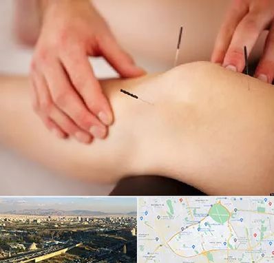 دکتر طب سوزنی برای لاغری در منطقه 19 تهران 