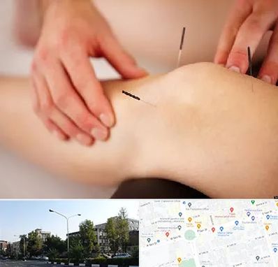 دکتر طب سوزنی برای لاغری در میدان کاج 