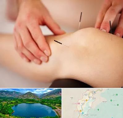 دکتر طب سوزنی برای لاغری در رودبار
