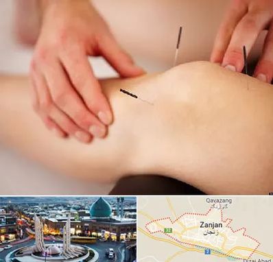 دکتر طب سوزنی برای لاغری در زنجان