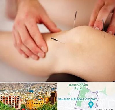 دکتر طب سوزنی برای لاغری در نیاوران 