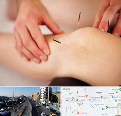 دکتر طب سوزنی برای لاغری در پیروزی 