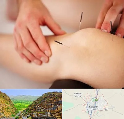دکتر طب سوزنی برای لاغری در کامیاران