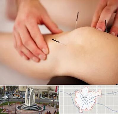 دکتر طب سوزنی برای لاغری در زابل