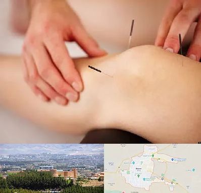 دکتر طب سوزنی برای لاغری در بیرجند