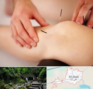 دکتر طب سوزنی برای لاغری در علی آباد کتول