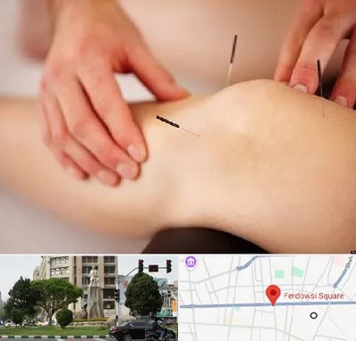 دکتر طب سوزنی برای لاغری در میدان فردوسی تهران