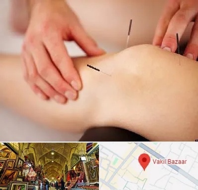 دکتر طب سوزنی برای لاغری در بازار وکیل شیراز
