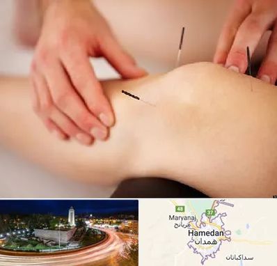 دکتر طب سوزنی برای لاغری در همدان