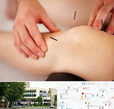 دکتر طب سوزنی برای لاغری در طالقانی 