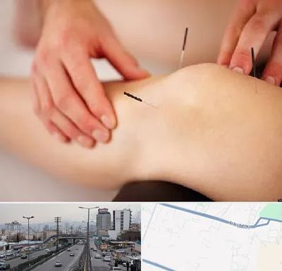 دکتر طب سوزنی برای لاغری در بلوار ارتش