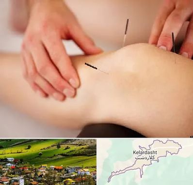 دکتر طب سوزنی برای لاغری در کلاردشت