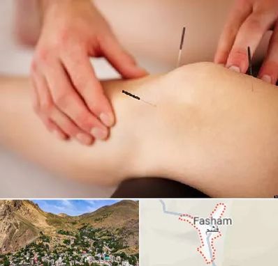 دکتر طب سوزنی برای لاغری در فشم