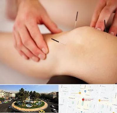 دکتر طب سوزنی برای لاغری در هفت حوض 