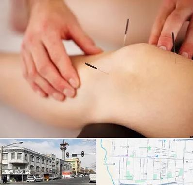 دکتر طب سوزنی برای لاغری در 17شهریور