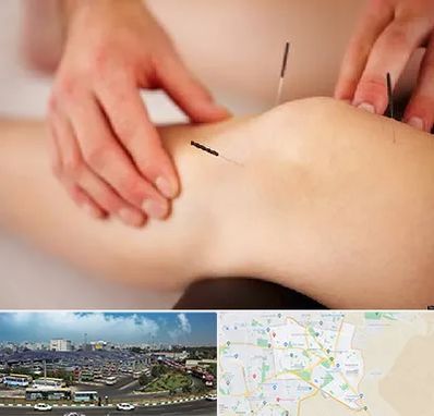 دکتر طب سوزنی برای لاغری در منطقه 15 تهران 