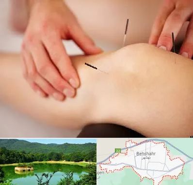 دکتر طب سوزنی برای لاغری در بهشهر
