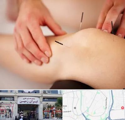 دکتر طب سوزنی برای لاغری در ایران زمین