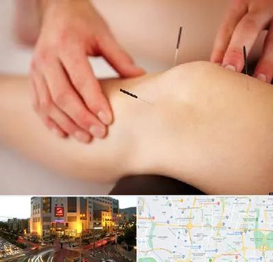 دکتر طب سوزنی برای لاغری در جنت آباد تهران 