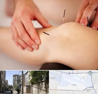دکتر طب سوزنی برای لاغری در مهرآباد