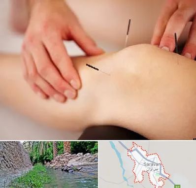 دکتر طب سوزنی برای لاغری در سراوان