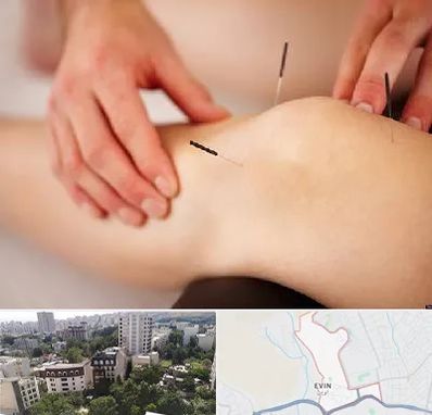 دکتر طب سوزنی برای لاغری در اوین