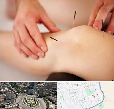 دکتر طب سوزنی برای لاغری در زرافشان اسلامشهر 