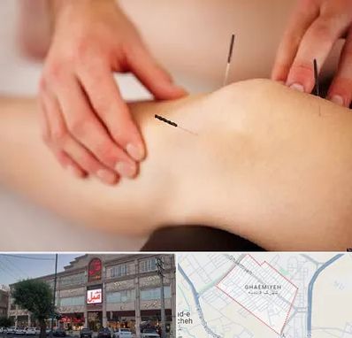 دکتر طب سوزنی برای لاغری در قائمیه اسلامشهر 