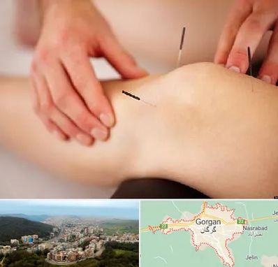 دکتر طب سوزنی برای لاغری در گرگان