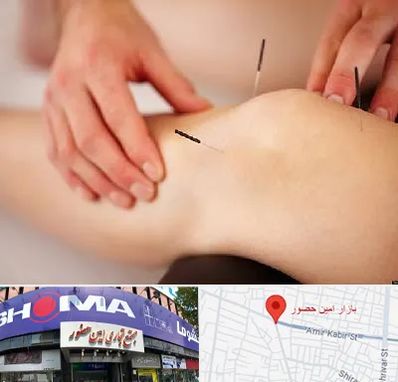 دکتر طب سوزنی برای لاغری در امین حضور