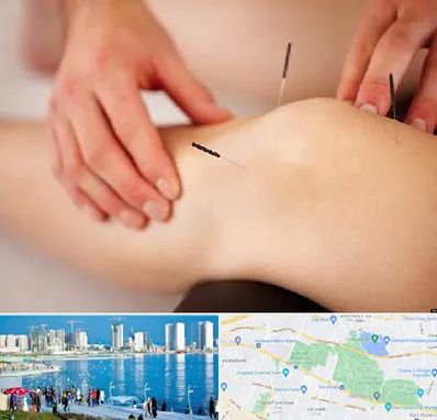 دکتر طب سوزنی برای لاغری در چیتگر 