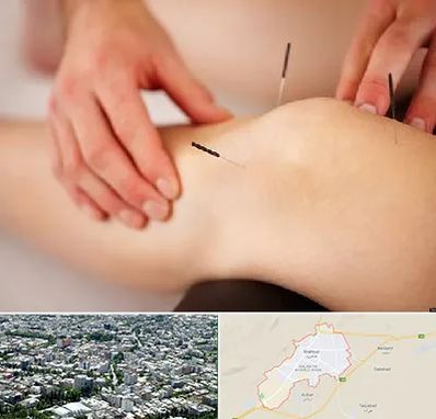 دکتر طب سوزنی برای لاغری در شاهرود