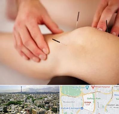 دکتر طب سوزنی برای لاغری در گیشا 