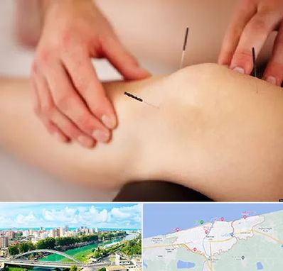 دکتر طب سوزنی برای لاغری در بابلسر