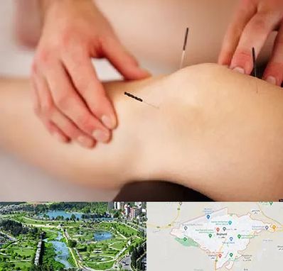 دکتر طب سوزنی برای لاغری در بجنورد