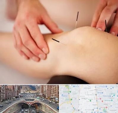 دکتر طب سوزنی برای لاغری در منطقه 10 تهران 