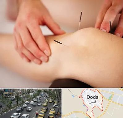 دکتر طب سوزنی برای لاغری در شهر قدس