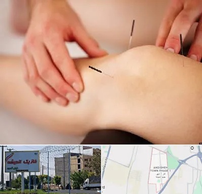 دکتر طب سوزنی برای لاغری در فاز یک اندیشه