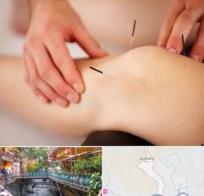 دکتر طب سوزنی برای لاغری در درکه