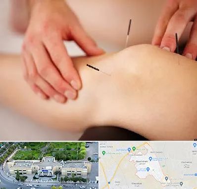 دکتر طب سوزنی برای لاغری در نسیم شهر
