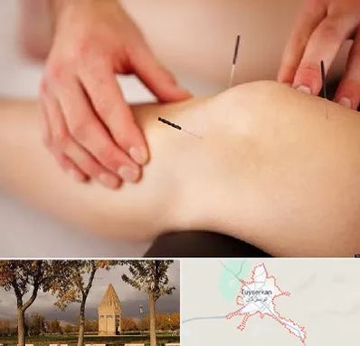 دکتر طب سوزنی برای لاغری در تویسرکان