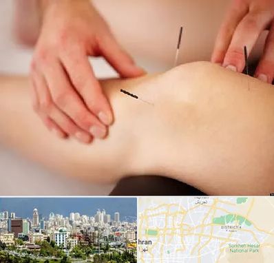 دکتر طب سوزنی برای لاغری در شرق تهران 