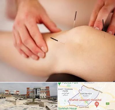 دکتر طب سوزنی برای لاغری در حکیمیه
