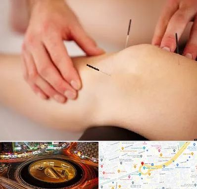 دکتر طب سوزنی برای لاغری در میدان ولیعصر 